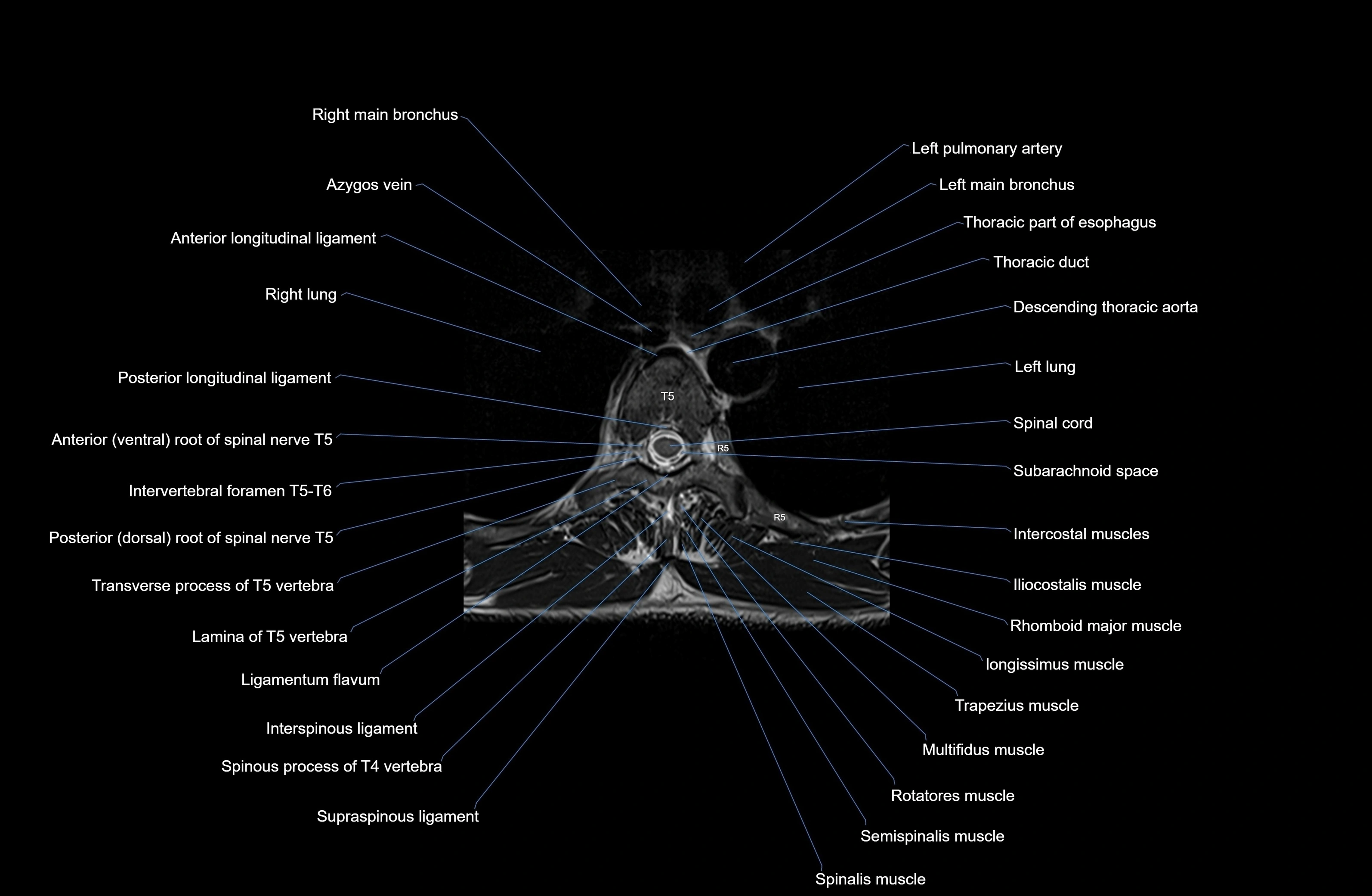 MRI thoracic spine axial  cross sectional anatomy 3T radiology  image-img-00001-00032.webp